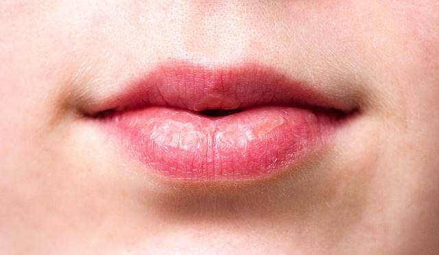 dudak-catlamasina-en-iyi-gelen-krem